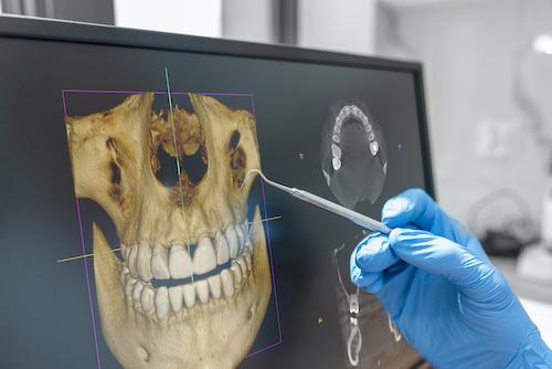X-ray of a persons mouth, fort collins co