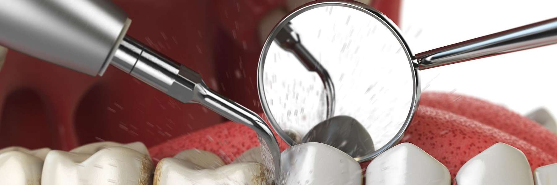 Teeth being cleaned, fort collins co