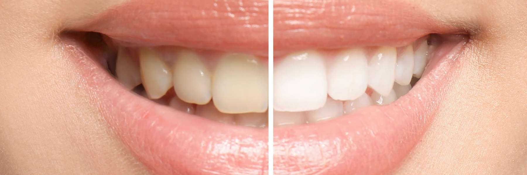 Before and after image of teeth, fort collins co